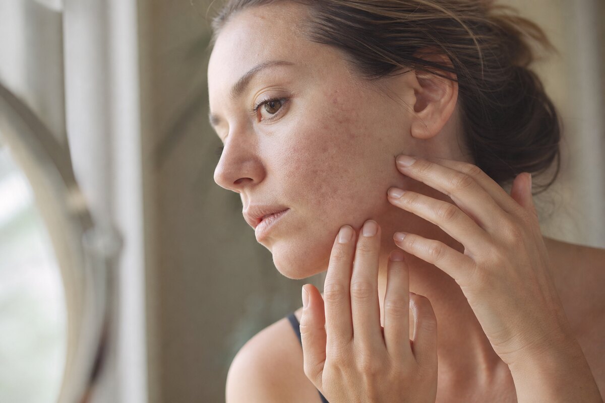 American woman examining cheek texture and post-acne marks near a window in natural light
